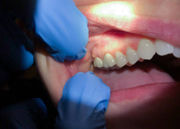 Best Emergency Dentist for Lost Fillings or Crowns in Salmon Creek, WA